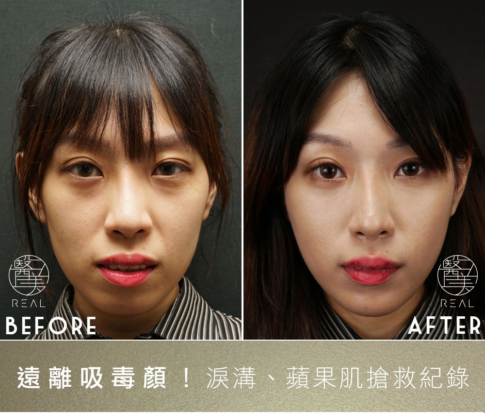 遠離吸毒顏 淚溝 蘋果肌搶救紀錄