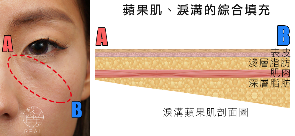 3D多層注射填補原理