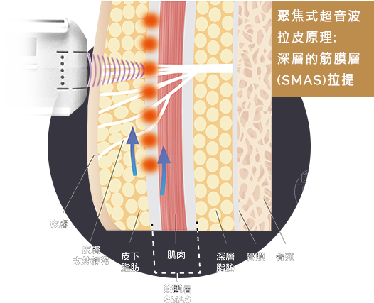 超音波拉皮拉提筋膜層收縮